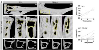 Simulazione della progressione osteolitica all’interno di A(BM)². A. Osteolisi indotta dal tumore, in vivo, analizzata tramite µCT; sono riportate immagini della progressione nel tempo e la quantificazione dell’area ossea riassorbita (lesioni singole, n = 3–7 lesioni/osso).