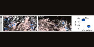 B. Analisi di immunofluorescenza; OC, TRAP; tumore, GFP; osso, SHG. È mostrata la quantificazione del numero di OC, boxplot con mediana; valori di P calcolati con test t di Student non appaiato a due code, p < 0,01 (**)
